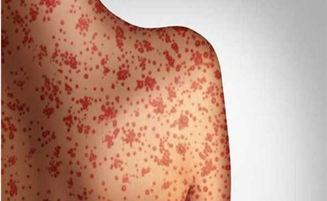 Measles in mangolia 700x430