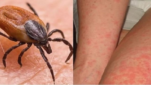 Scrub typhus